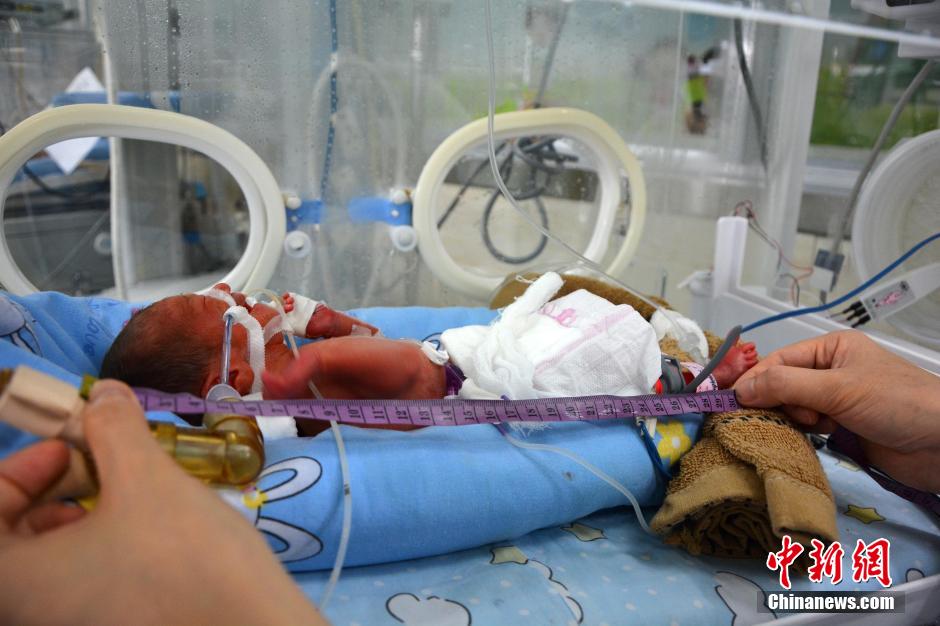 湖南首例袖珍婴儿创造生命奇迹将出院