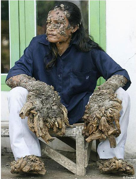 胆小慎入！9种几乎没有人见过的超罕见疾病