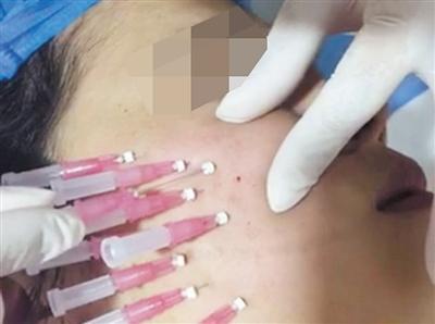 揭秘微整形培训机构：学员互当“小白鼠”学扎针