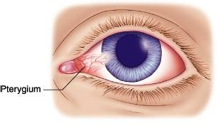 眼睛长胬肉怎么办?成都爱尔眼科角膜缘干细胞