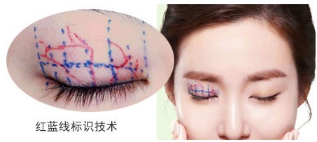贝塞尔曲线原理 在双眼皮手术应用中的优势__