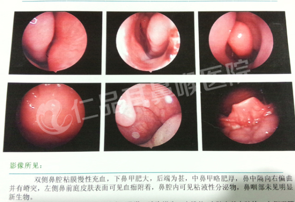 成都仁品医院鼻粘膜夹板技术 专科治疗鼻中隔偏曲等鼻病_ 联盟中国 _ 中国网
